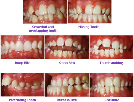 Childrens orthodontics