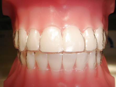 Orthosmile Orthodontics offers both ClearSmile and Invisalign.