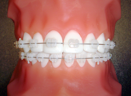 Orthosmile Orthodontics offers patients clear braces: a more discreet option over traditional braces.