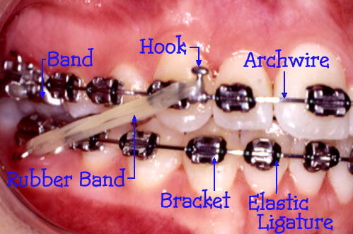 Is a Loose Bracket an Orthodontic Emergency