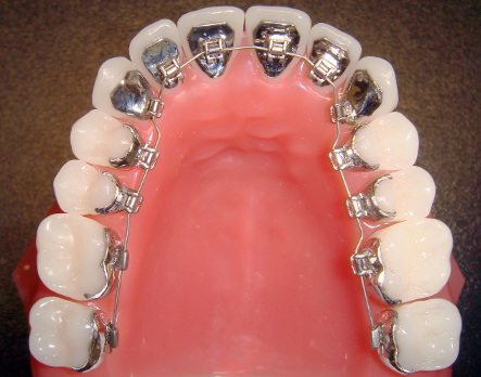 Orthosmile Orthodontics offers lingual braces, attached to the back of your teeth, so no one will see your getting treatment.