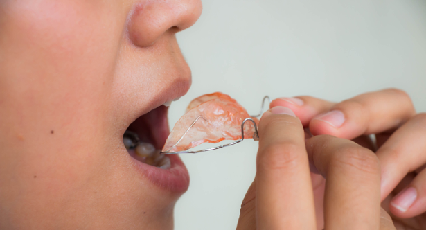 Retaining your smile: wear a retainer to maintain straight teeth