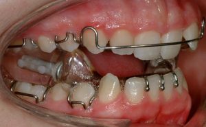 jaw1